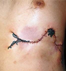 症例35　刺青（タトゥー）除去（皮膚組織伸展法） 手術直後