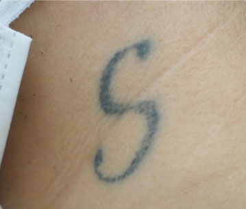 症例5　刺青（タトゥー）除去（レーザー） 治療前