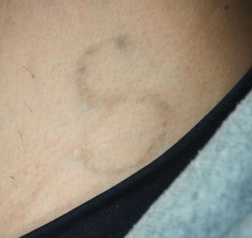 症例5　刺青（タトゥー）除去（レーザー） 治療2回後