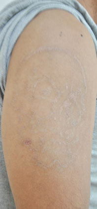 症例6　刺青（タトゥー）除去（レーザー＋削皮） 治療後
