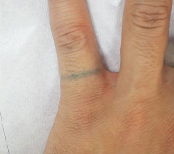 症例7　刺青（タトゥー）除去（レーザー治療後に切縫法手術） レーザー治療後