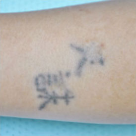 症例8　刺青（タトゥー）除去（切縫法） 手術前