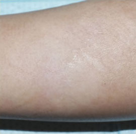 症例8　刺青（タトゥー）除去（切縫法） 手術後