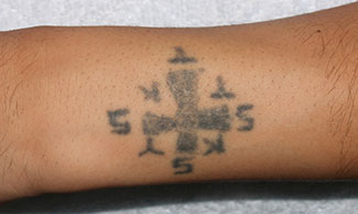 症例9　刺青（タトゥー）除去（切縫法） 手術前