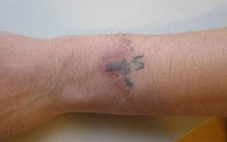 症例9　刺青（タトゥー）除去（切縫法） 第1回手術後