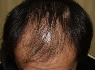 症例10　頭髪治療（薄毛、抜け毛治療） 治療前