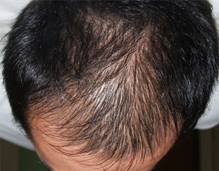 症例10　頭髪治療（薄毛、抜け毛治療） 治療中(3ヶ月経過)