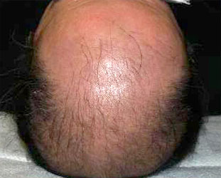 症例11　頭髪治療（薄毛、抜け毛治療） 治療前