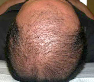 症例11　頭髪治療（薄毛、抜け毛治療） 治療中(6ヶ月経過)