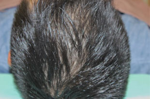 症例12　頭髪治療（薄毛、抜け毛治療） 治療前