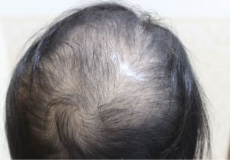 症例13　頭髪治療（薄毛、抜け毛治療） 治療前