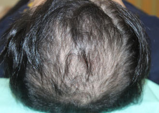 症例13　頭髪治療（薄毛、抜け毛治療） 治療中(3ヶ月経過)
