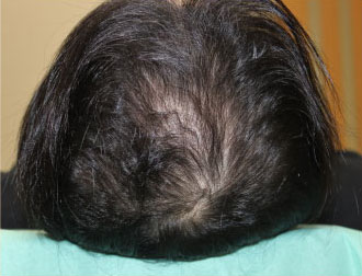 症例13　頭髪治療（薄毛、抜け毛治療） 治療後(6ヶ月経過)