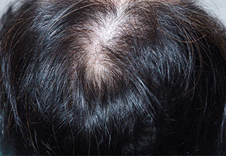 症例1　女性頭髪治療（薄毛、抜け毛治療） 治療前