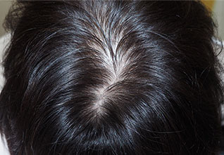 症例1　女性頭髪治療（薄毛、抜け毛治療） 治療中(8ヶ月経過)