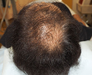 症例2　女性頭髪治療（薄毛、抜け毛治療） 治療前