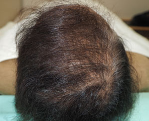 症例2　女性頭髪治療（薄毛、抜け毛治療） 治療後(3ヶ月経過)