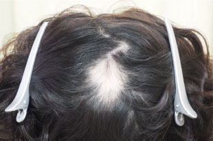 症例3　女性頭髪治療（薄毛、抜け毛治療） 治療前