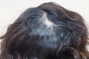 症例3　女性頭髪治療（薄毛、抜け毛治療） 治療後(3ヶ月経過)