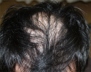 症例1　頭髪治療（薄毛、抜け毛治療） 治療前