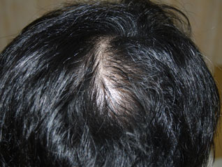 症例1　頭髪治療（薄毛、抜け毛治療） 治療中(4ヶ月経過)