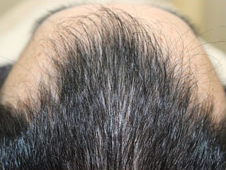 症例2　頭髪治療（薄毛、抜け毛治療） 治療中(4ヶ月経過)