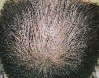 症例3　頭髪治療（薄毛、抜け毛治療） 治療前