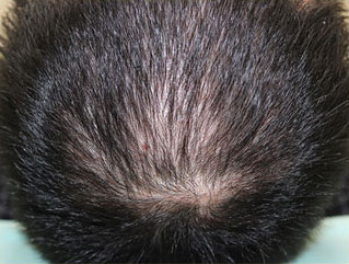 症例3　頭髪治療（薄毛、抜け毛治療） 治療中(4ヶ月経過)