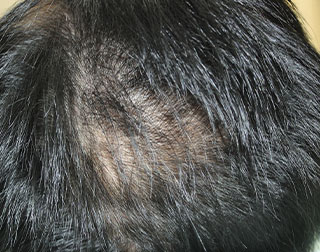 症例4　頭髪治療（薄毛、抜け毛治療） 治療前