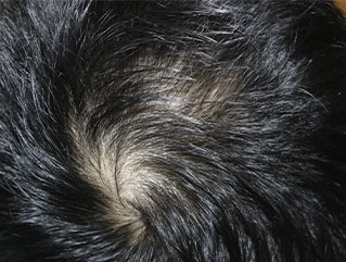 症例4　頭髪治療（薄毛、抜け毛治療） 治療中(4ヶ月経過)