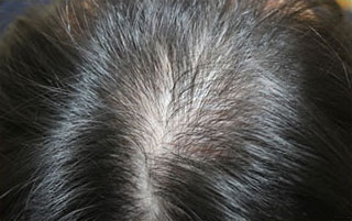 症例5　頭髪治療（薄毛、抜け毛治療） 治療前