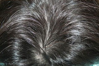 症例5　頭髪治療（薄毛、抜け毛治療） 治療中(4ヶ月経過)