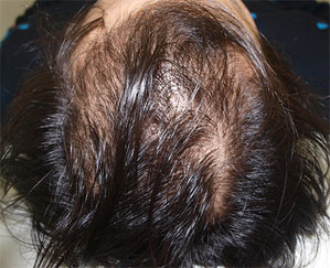 症例6　頭髪治療（薄毛、抜け毛治療） 治療前
