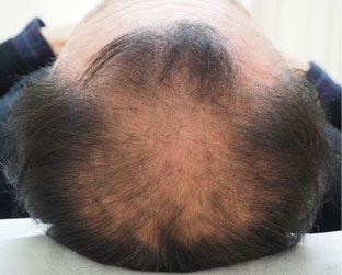 症例7　頭髪治療（薄毛、抜け毛治療） 治療前