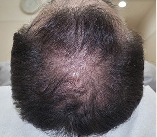 症例7　頭髪治療（薄毛、抜け毛治療） 治療中(9ヶ月経過)