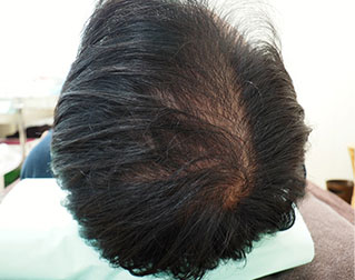 症例8　頭髪治療（薄毛、抜け毛治療） 治療前