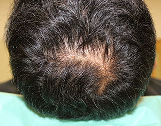 症例9　頭髪治療（薄毛、抜け毛治療） 治療前