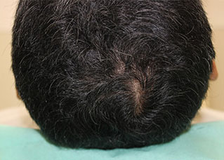 症例9　頭髪治療（薄毛、抜け毛治療） 治療中(4ヶ月経過)